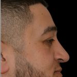 Rhinoplasty Before & After Patient #18030