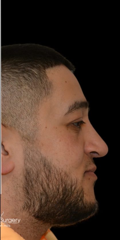 Rhinoplasty Before & After Patient #18030