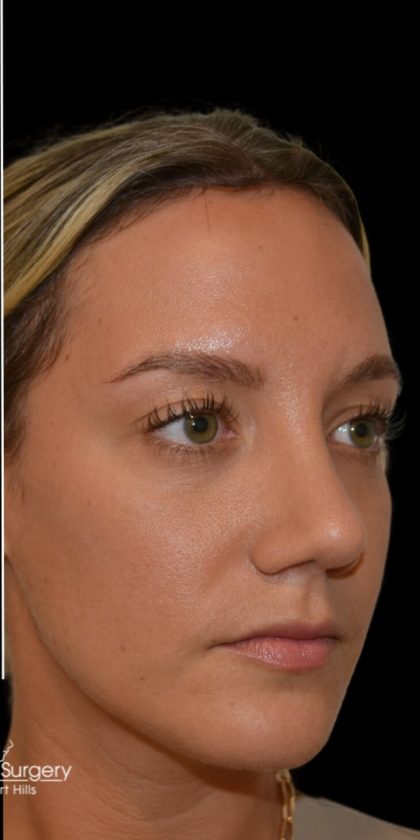 Rhinoplasty Before & After Patient #18031