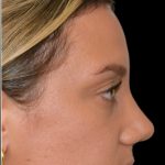 Rhinoplasty Before & After Patient #18031