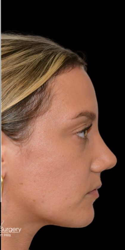 Rhinoplasty Before & After Patient #18031