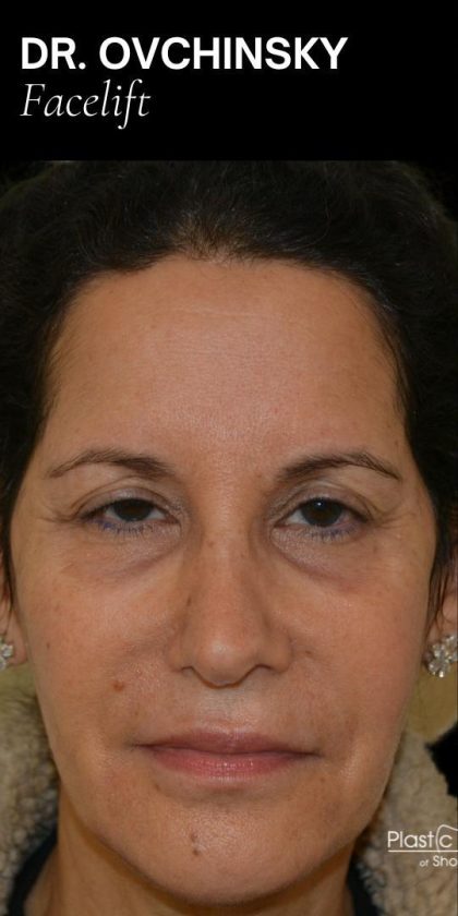 Facelift Before & After Patient #18059
