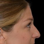 Rhinoplasty Before & After Patient #18061