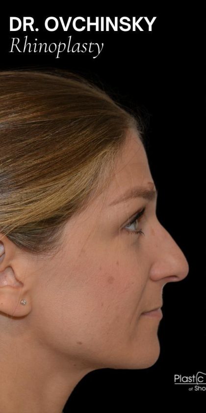 Rhinoplasty Before & After Patient #18061