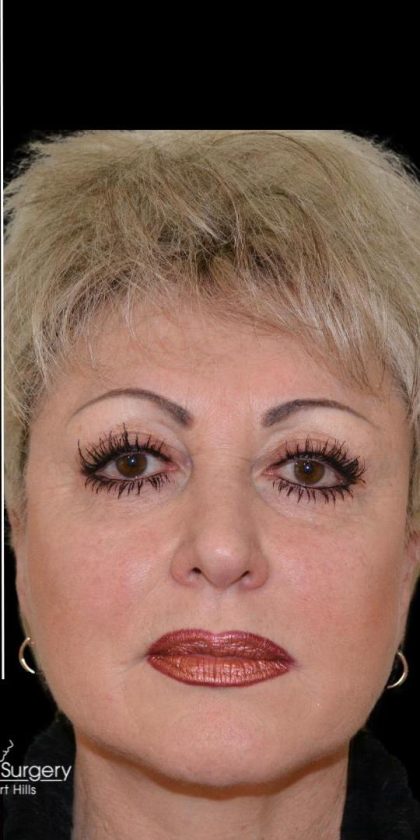 Facelift Before & After Patient #18060