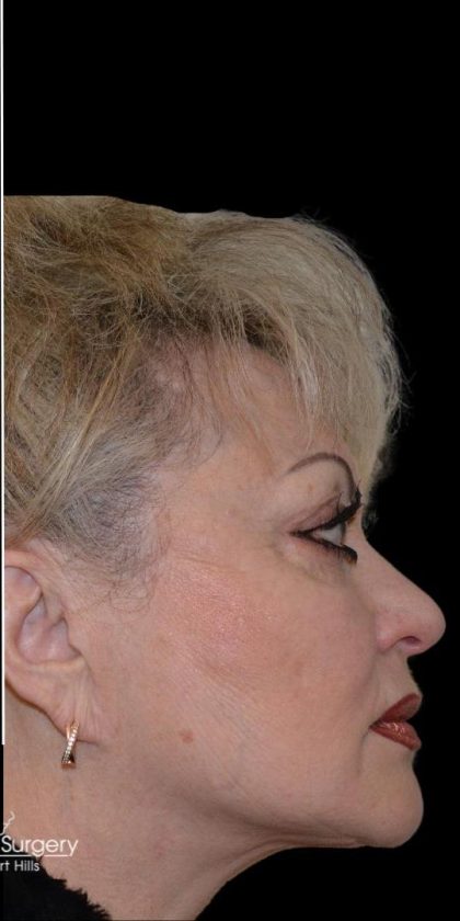 Facelift Before & After Patient #18060