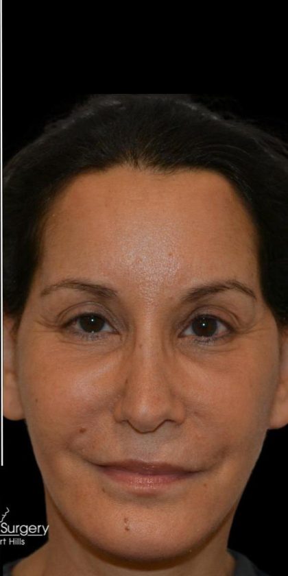 Facelift Before & After Patient #18059