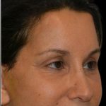 Facelift Before & After Patient #18059