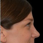 Rhinoplasty Before & After Patient #18061