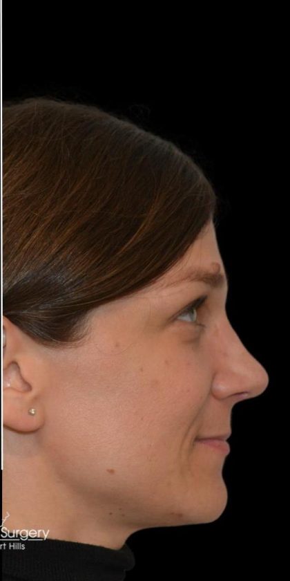 Rhinoplasty Before & After Patient #18061