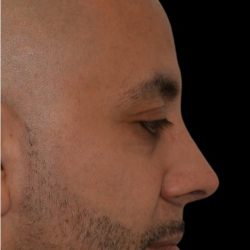 Rhinoplasty Before & After Patient #18351