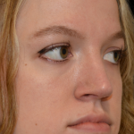 Rhinoplasty Before & After Patient #18263