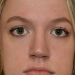 Rhinoplasty Before & After Patient #18263