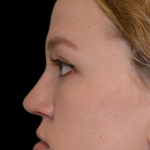 Rhinoplasty Before & After Patient #18263