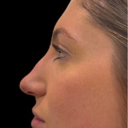 Liquid Rhinoplasty(Non-Surgical) Before & After Patient #18265