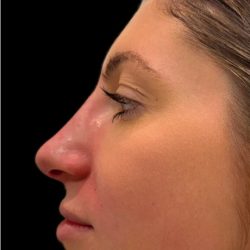 Liquid Rhinoplasty(Non-Surgical) Before & After Patient #18265