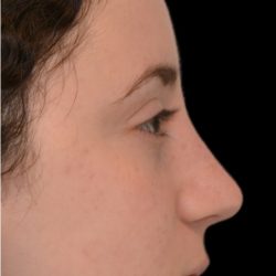 Rhinoplasty Before & After Patient #18270