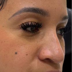 Liquid Rhinoplasty(Non-Surgical) Before & After Patient #18264