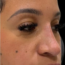Liquid Rhinoplasty(Non-Surgical) Before & After Patient #18264