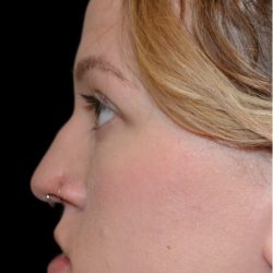Rhinoplasty Before & After Patient #18263