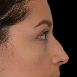 Rhinoplasty Before & After Patient #18269