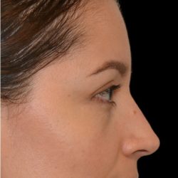 Rhinoplasty Before & After Patient #18269