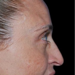 Rhinoplasty Before & After Patient #18267