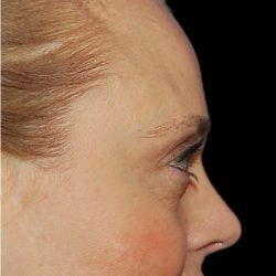 Rhinoplasty Before & After Patient #18267