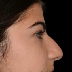Rhinoplasty Before & After Patient #18266