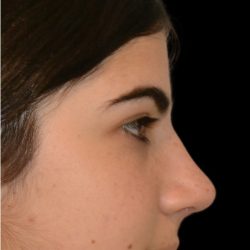 Rhinoplasty Before & After Patient #18266