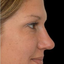 Rhinoplasty Before & After Patient #18464