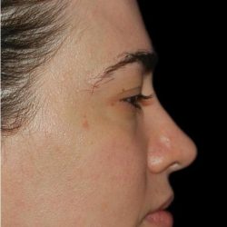Rhinoplasty Before & After Patient #18475