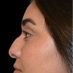 Rhinoplasty Before & After Patient #18555