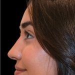 Rhinoplasty Before & After Patient #18555