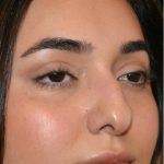 Rhinoplasty Before & After Patient #18555