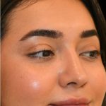 Rhinoplasty Before & After Patient #18555