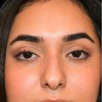 Rhinoplasty Before & After Patient #18555