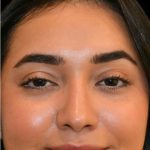 Rhinoplasty Before & After Patient #18555