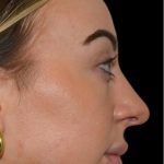 Rhinoplasty Before & After Patient #18557