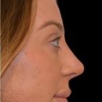Rhinoplasty Before & After Patient #18557