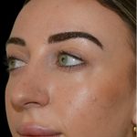 Rhinoplasty Before & After Patient #18557