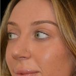 Rhinoplasty Before & After Patient #18557