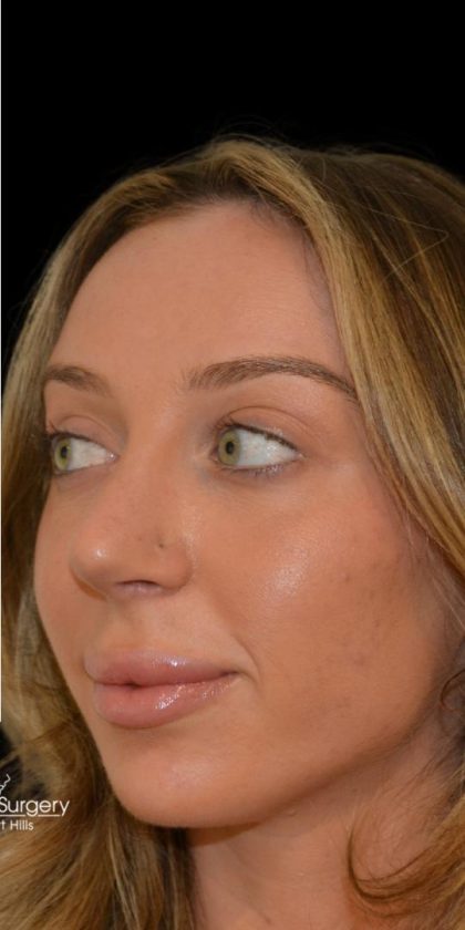 Rhinoplasty Before & After Patient #18557