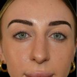 Rhinoplasty Before & After Patient #18557