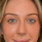 Rhinoplasty Before & After Patient #18557