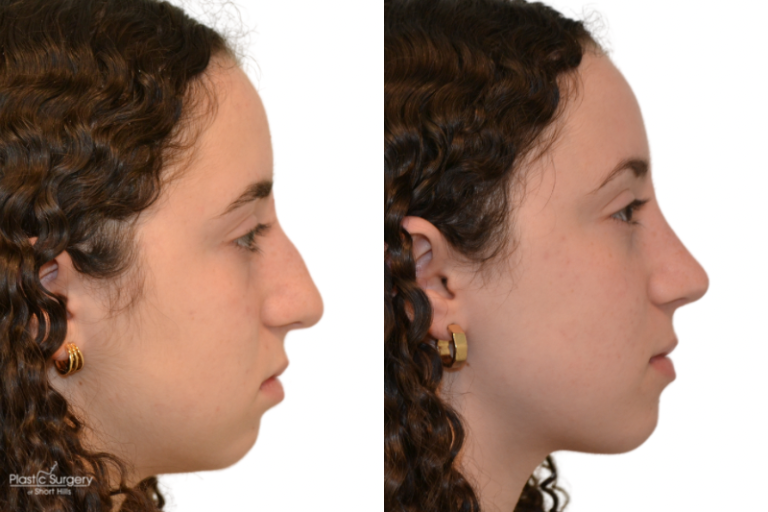 Best Rhinoplasty New Jersey, New York | Plastic Surgery of Short Hills