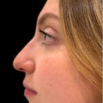 Liquid Rhinoplasty(Non-Surgical) Before & After Patient #18907