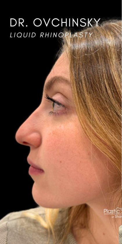 Liquid Rhinoplasty(Non-Surgical) Before & After Patient #18907