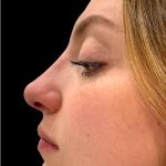 Liquid Rhinoplasty(Non-Surgical) Before & After Patient #18907