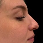 Liquid Rhinoplasty(Non-Surgical) Before & After Patient #18907